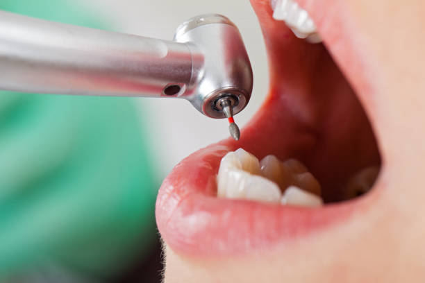 Best Emergency Root Canal Treatment in Bath, ME